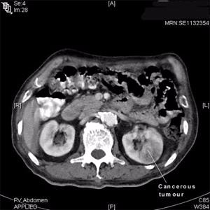 This is a CT scan that shows kidney cancer.