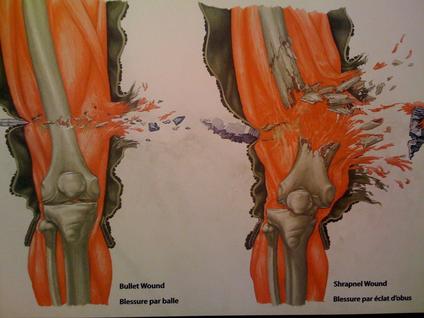 Schrapnel Injuries Did you know?