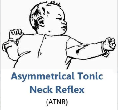 Example of a Tonic Reflex