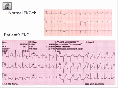 This is our patient's EKG results compared to normal EKG results. As ...