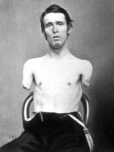 A soldier that suffered arm injuries during World War 1.