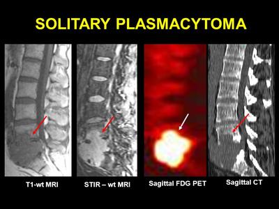 This image is showing what a MRI and PET scan would look like of a ...