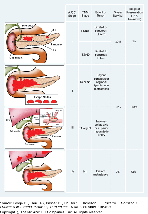 Stages Of Pancreatic Cancer 7887