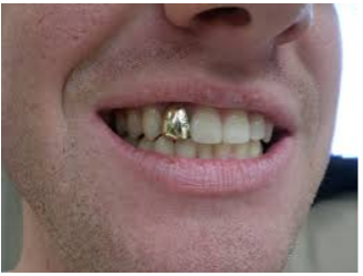 http://www.punchnels.com/2012/02/09/gold-teeth/