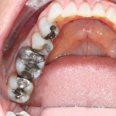 healing translucent tooth enamel healing translucent tooth enamel
