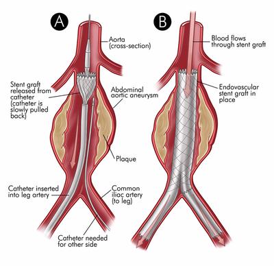 Endovascular Aneurysm Repair