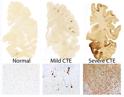 Stages of CTE in a brain