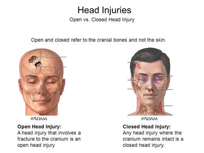 Phineas Gage luckily suffered an open head injury, otherwise he likely ...